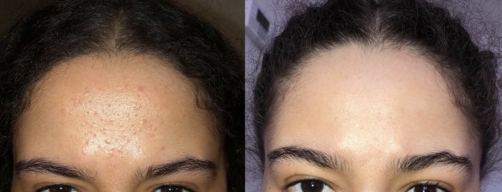 The Acne Diaries – Part 3: My Miracle&nbsp;Cream!